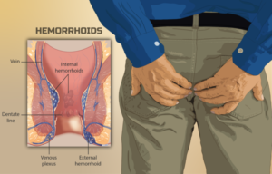 Person experiencing discomfort from piles